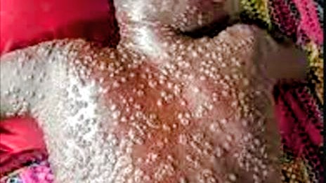 Kasaï : alerte au Mpox à Luebo, plus de 20 cas suspects signalés